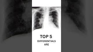 Hilar enlargement on chest X-ray?