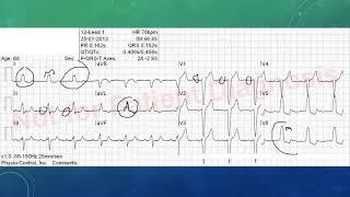 EKG befunden leicht gemacht, EKG Beispiele