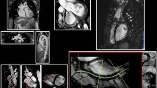 MRI Coronary Arteries @ Siemens 3T Skyra