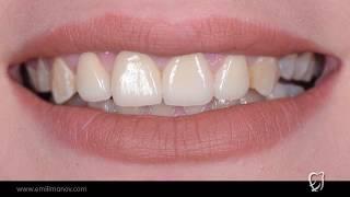 Frontal bölgədə gummy smile və İMPLANT  (İMPLANTOLOQ STOMATOLOQ Dr. EMİL İMANOV)