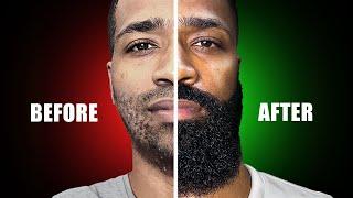 watch this if you have a patchy beard (science based)