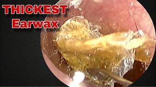 Remove Thick Earwax from the patient | Doctor Anh