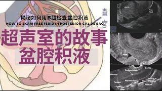 盆腔积液：B超报告上的‘盆腔积液’ 是什么/为什么有盆腔积液/不同类别/症状/B超是如何检查盆腔积液的/治疗方法【Ultrasound Room】Free Fluid in Cal de sac