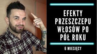 Efekty przeszczepu włosów po pół roku - 6 MIESIĘCY PO PRZESZCZEPIE