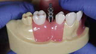 Open Tray Impression - How to take an open tray impression