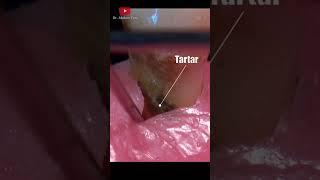 Tooth extraction with periodontitis