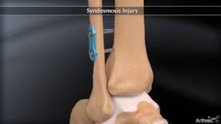 Syndesmosis Injury