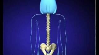 Medical AnimationScoliosis surgery. Video produced by MVR.