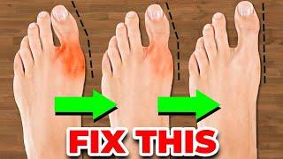 How To Fix Bunions | Hallux Valgus