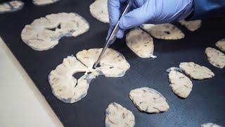 Where does Alzheimer's begin?