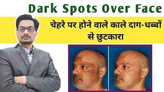 Hyperpigmentation: Causes & Best Treatments | Dark Spots का इलाज by Dermatologist Dr. Sanjay Singh