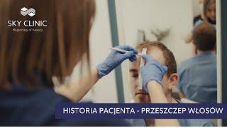 Przeszczep włosów w Sky Clinic - Cały proces krok po kroku