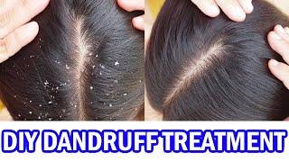 How to Get Rid of Dandruff Permanently at Home | Top DIY Treatments & Remedies for Flaky Scalp