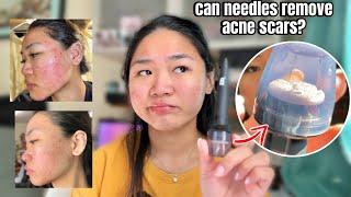 🪡 Needles can remove ACNE SCARS?