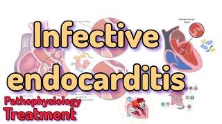 Infective endocarditis | Pathophysiology and Treatment