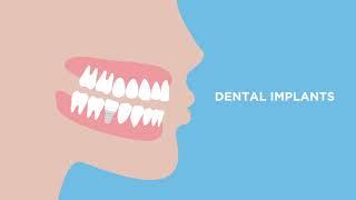 Dental Implants- Short Video (AAOMS)