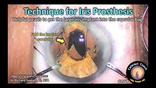 CataractCoach 1568: technique for artificial iris prosthesis