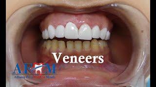 3D Veneers, Fashion Smile!!