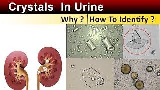 Crystals In Urine  ( Why & How to Identify ? )