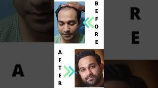 Best Hair Transplant Results with Before After Images | Total Grafts Implanted 5248 | After 2 years