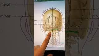 ￼Neuralgia Arnold .- Dolor Posterior en la Cabeza