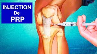 ARTHROSE DU GENOU : Injection de PRP (Plasma riche en plaquettes)