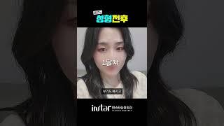 '찐' 무쌍 눈매교정 후기 : 눈 뜨는 게, 인상이 이렇게 다르다고요..? #강남성형외과#인스타성형외과 #무쌍눈매교정 #무쌍성형 #무쌍수술 #무쌍메이크업 #무쌍 #눈성형