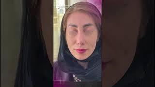 3 weeks after rhinoplasty | dr zahra karbasi #nosejob