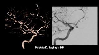 Microsurgical Clipping of Ruptured Anterior Communicating Artery (AComA) Aneurysm