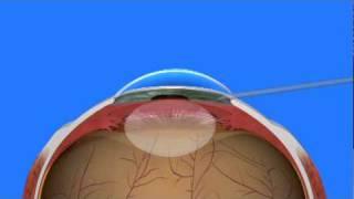 Cataract Surgery