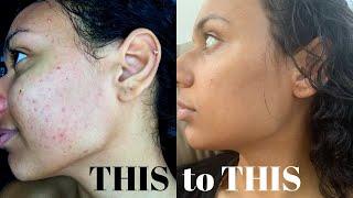 How To Naturally Clear Acne & Acne Scarring