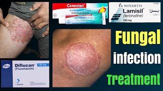 Tinea cruris | how to treat fungal infection | tinea capitis | fungal infection in private parts