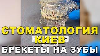 Стоматология Киев: Брекеты на зубы   #Shorts