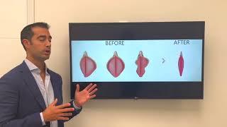 Labiaplasty with Dr. Zuri in Miami | Zuri Plastic Surgery