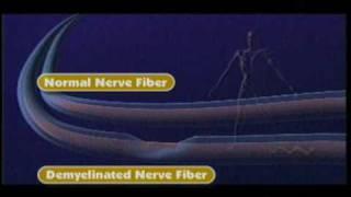 Types of Fatigue in MS - National MS Society