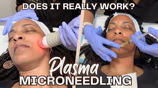 Full Process of my PRP Microneedling for the 1st Time | Will it work?