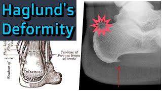 Haglund's Deformity
