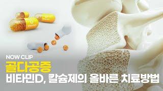 골다공증 비타민D, 칼슘제의 올바른 치료방법