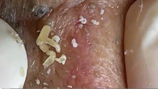 Massive Blackheads removal pops #13