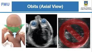 Fetal Anomaly Scan (How To) - Mr S. Chigayo