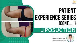 Patient Experience Series: Liposuction Procedure | The Venkat Center for Skin and Plastic Surgery