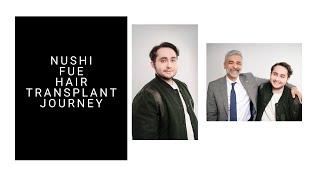 Nushi FUE Hair Transplant- Parsa Mohebi Hair Restoration