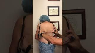 Bra Line Lift (Upper Body Lift) Pre operative Discussion with Dr. Michael Rossi