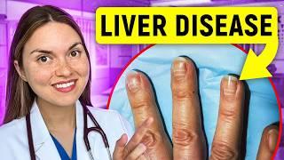 12 Signs of LIVER DISEASE You Can See: Doctor Explains