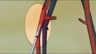 Animation E-Vita thoracic - JOTEC