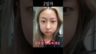 상여자 특: ￼사랑니 4개 한번에 뽑음