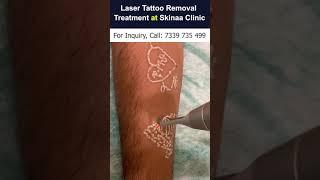 Laser Tattoo Removal at Skinaa Clinic l Viral #shorts