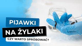 Pijawki Na Żylaki. Czy Pijawki Pomagają Na Żylaki?