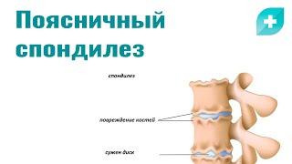 Поясничный спондилез: причины, симптомы и лечение