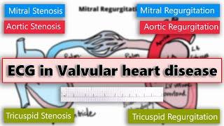 ECG changes in Valvular heart disease